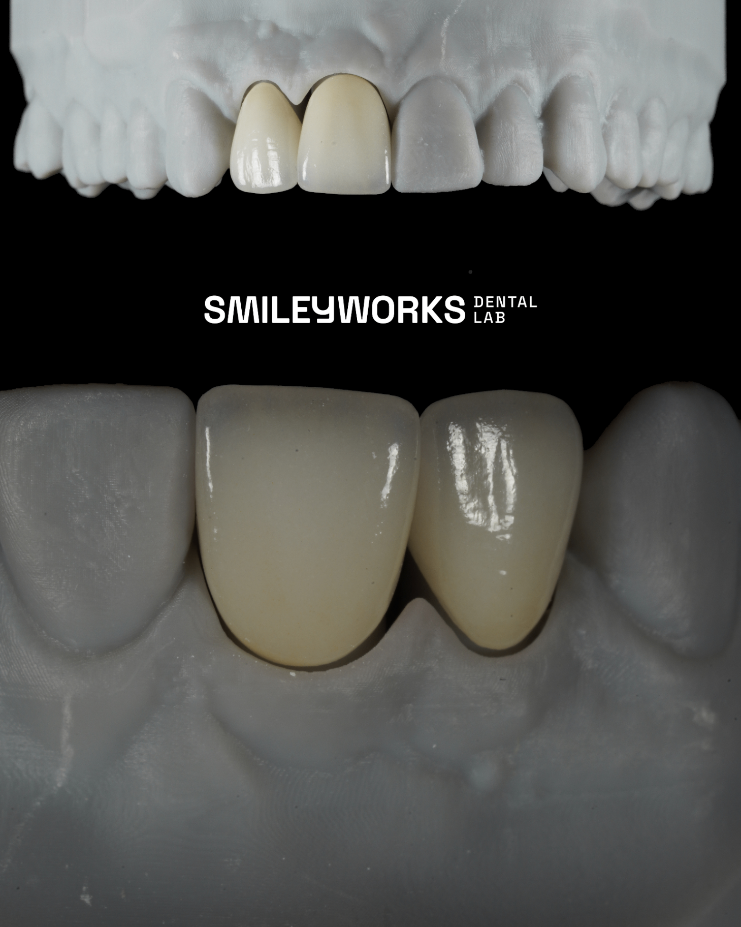 Microlayered Anterior Zirconia